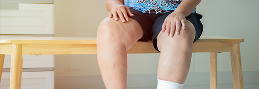 MedicalPoint International Hospital What are lymphedema and lipedema What is the difference